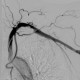 Cervical rib, compression of subclavian vein, trombosis of subclavian vein: AG - Angiography